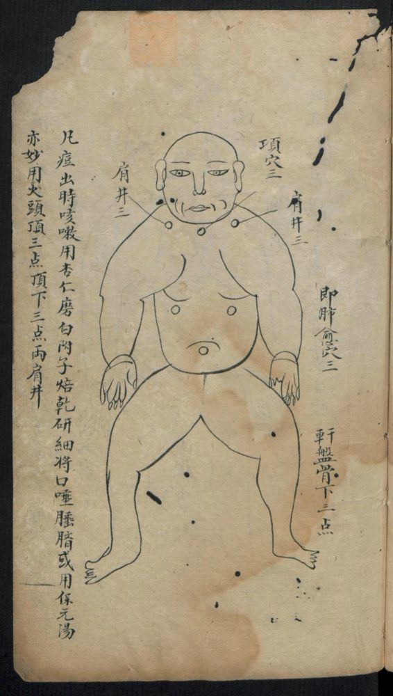 痘疹点烙及诊治(第19页)