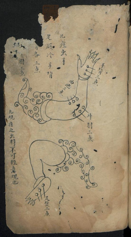 痘疹点烙及诊治(第3页)