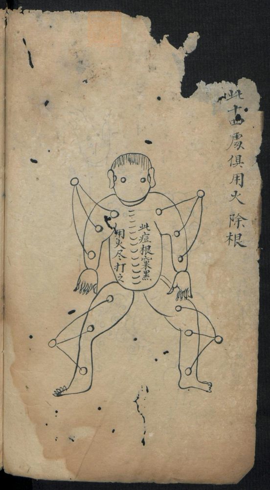 痘疹点烙及诊治(第4页)