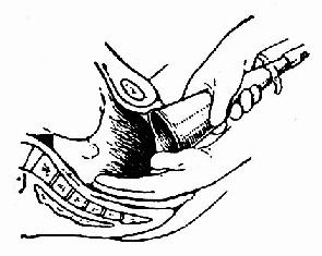 《妇产科学》_第一节 胎头吸引术及产钳术_中