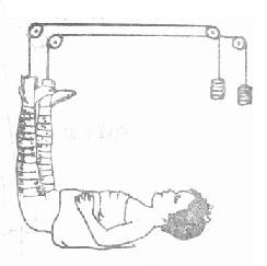 关于中医骨伤护理在60例股骨干骨折应用的本科毕业论文范文