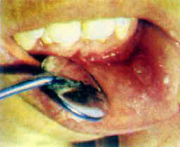 口腔黏膜疾病简述——复发性口疮