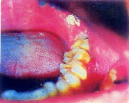 智齿冠周炎（Pericoronitis）——口腔颌面部炎症一