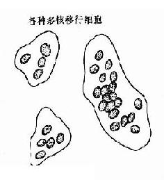 正常人尿液内的各种移行细胞示意图
