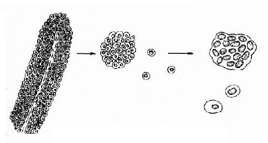 膀胱乳头瘤和脱落的瘤细胞示意图
