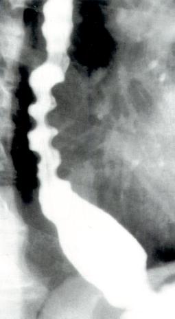 DES病人X线吞钡检查显示开塞钻食管