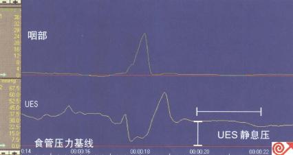 灌注式导管UES压力测定，显示了UES的静息压力