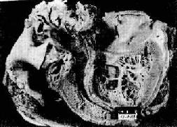 风湿性心内膜炎