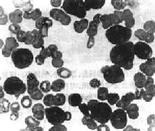 急性粒细胞性白血病