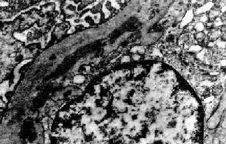膜性增生性肾小球肾炎Ⅰ型示意图