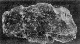 地方性甲状腺肿