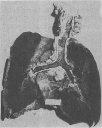 弥漫性肺出血型钩端螺旋体病的肺切面