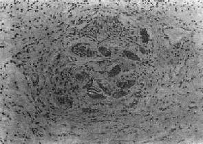 血吸虫病之慢性虫卵结节