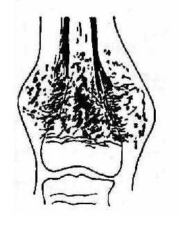股骨远侧干骺端骨肉瘤（硬化型）