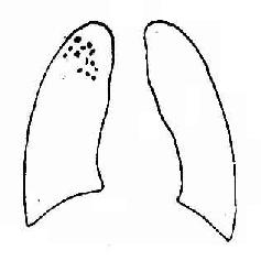 增殖性病变，各个病变界限分明，略呈梅花瓣状