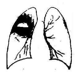 右肺上叶肺脓肿，空洞内有气液面，周围有广泛浸润