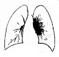 支气管淋巴结结核炎症型
