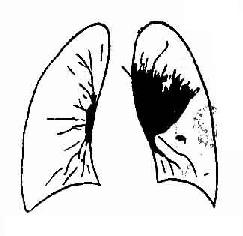 左侧肺门型肺癌