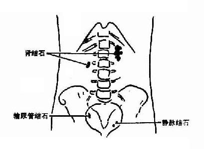 肾结石、右输尿管结石及左侧静脉结石