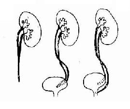 各种肾盂及输尿管的重复畸形