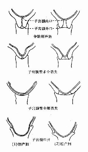 子宫颈管消失与子宫颈口扩张步骤