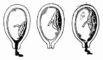 胎盘早期剥离的类型