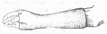 腕舟骨骨折的石膏固定