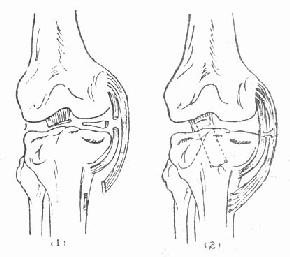 内侧副韧带和前十字韧带断裂合并内侧半月板破裂