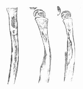 股骨化脓性骨髓炎