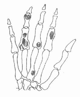 指（掌）骨多发性软骨瘤