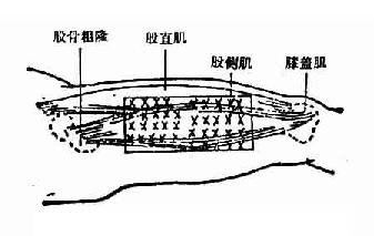 股外侧肌注射部位