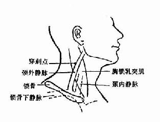 颈外静脉穿刺部位