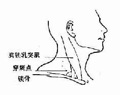 锁骨下静脉穿刺插管法