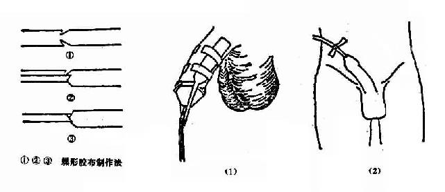 男病人留置导尿管固定法