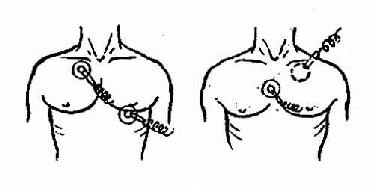胸外电击除颤电极板位置