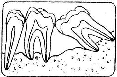 牙槽骨Ⅲ吸收