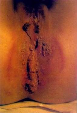 外阴、阴道、肛门周围尖锐湿疣病理发现细胞有恶变相