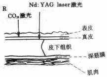CO2激光与Nd：YAG激光对皮肤作用示意图