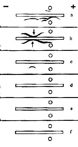 IgG重链病的免疫电泳图谱