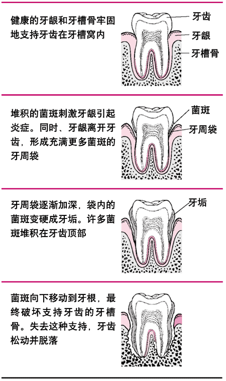 从菌斑到牙齿损失的过程