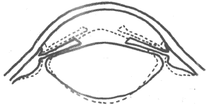 眼调节前后睫状体位置和晶状体形状的改变