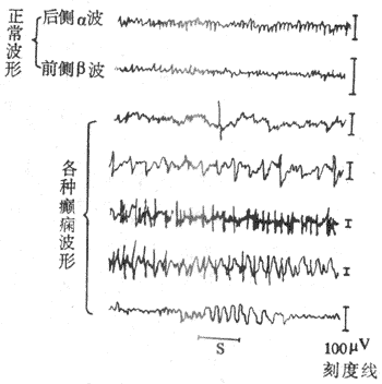 脑电图正常波形与癫痫波形的对比