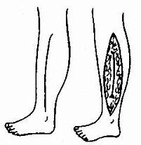 小腿外侧深筋膜切开减压