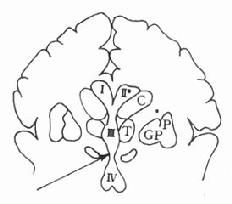 吗啡镇痛作用的部位（脑内）箭头表示第三脑室（Ⅲ）尾端、导水管周围灰质及第四脑室（Ⅳ）头端。