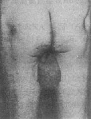 脆性X染色体（Fra X）综合征 患者大睾丸