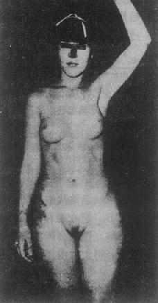 睾丸女性化综合征患者(核型46,XY)