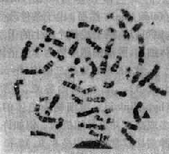 Ph染色体示 9；22易位（9q34;22q11）;→fi 22q-;▲示9+(晏炬提供)
