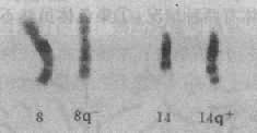 Burkitt淋巴瘤的14g+染色体8q24;14q32易位