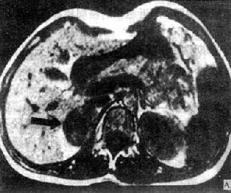 右肾上腺腺瘤MRI