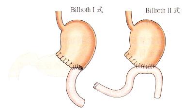 胃大部切除术毕二式图片